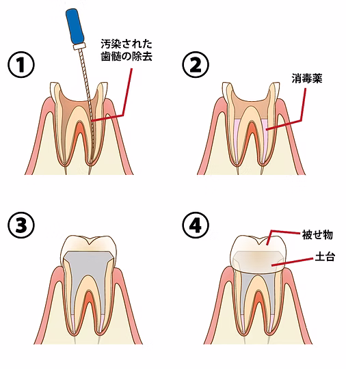 根管治療の流れ